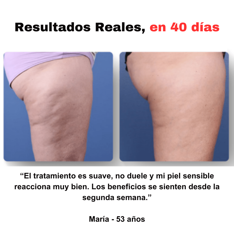 SmoothGlow™ - Masajeador anticelulítico - Dexvon