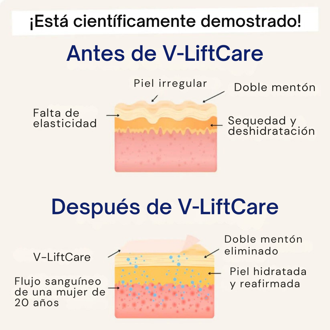 V-LiftCare™ – Reducción natural de papada