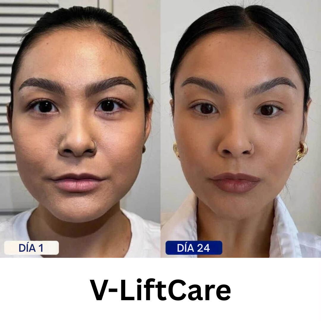V-LiftCare™ – Reducción natural de papada