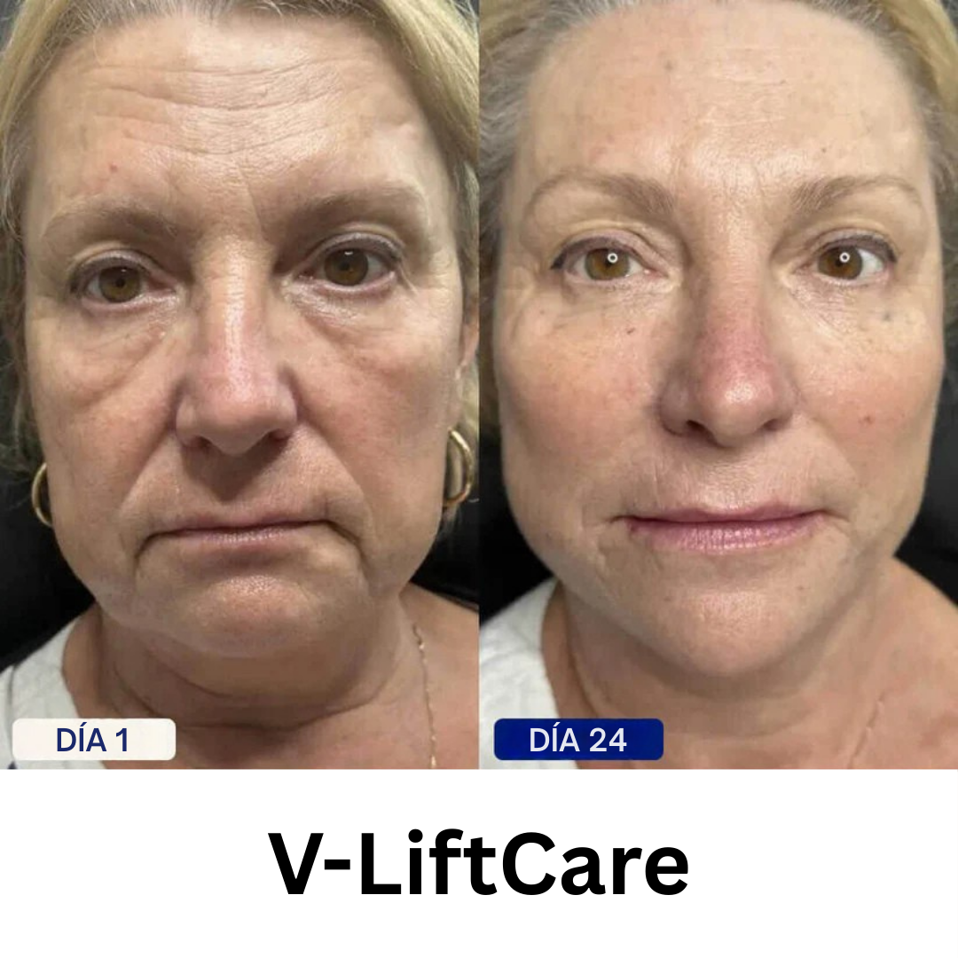 V-LiftCare™ – Reducción natural de papada