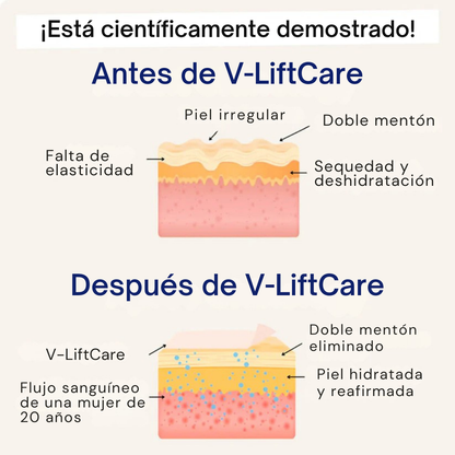 V-LiftCare™ – Reducción natural de papada