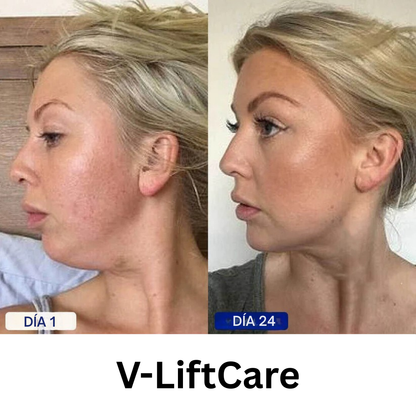 V-LiftCare™ – Reducción natural de papada