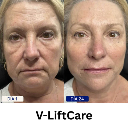 V-LiftCare™ – Reducción natural de papada