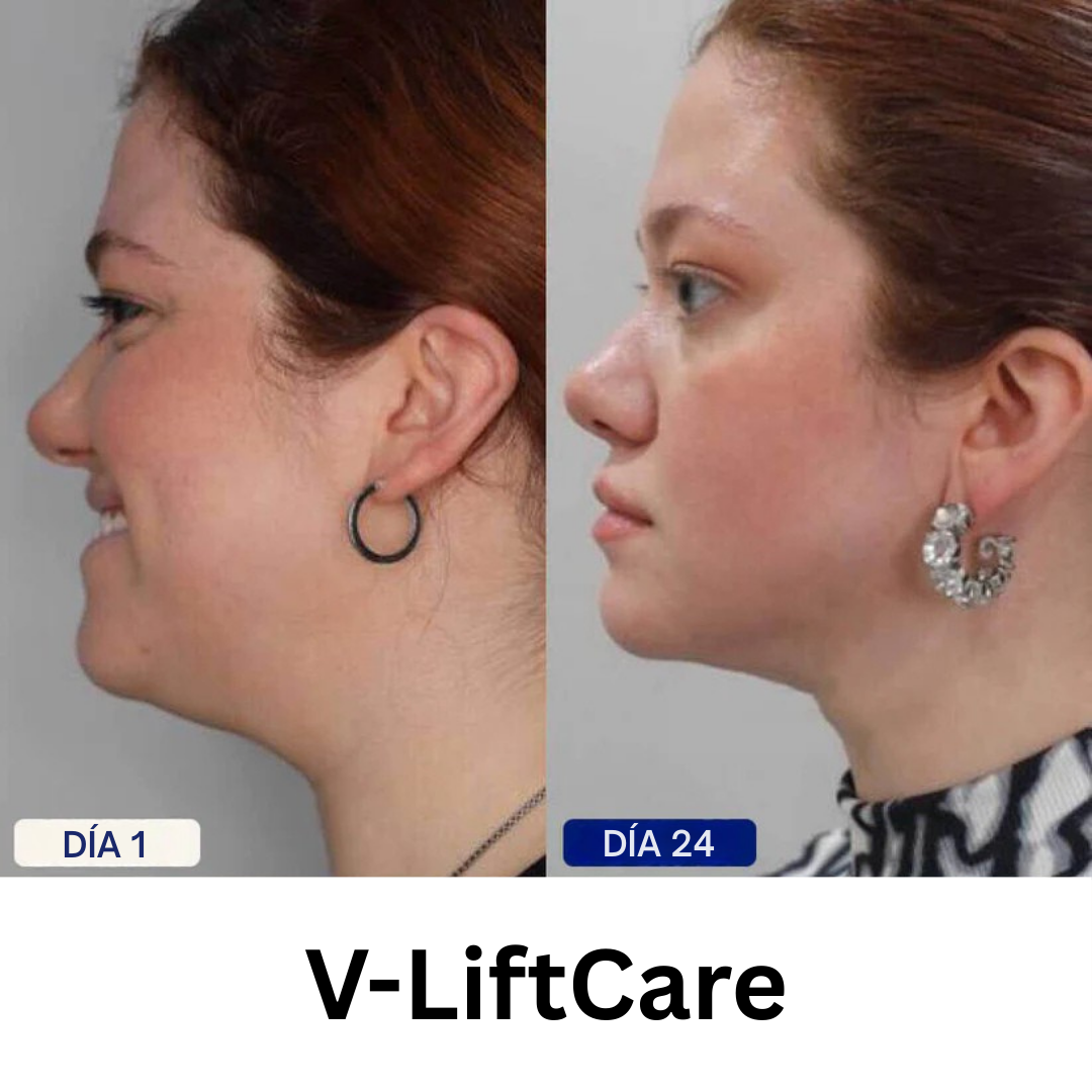 V-LiftCare™ – Reducción natural de papada